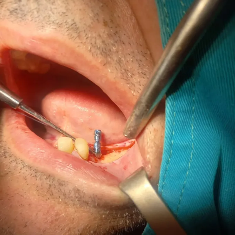 Ugradnja implantata u donjoj vilici