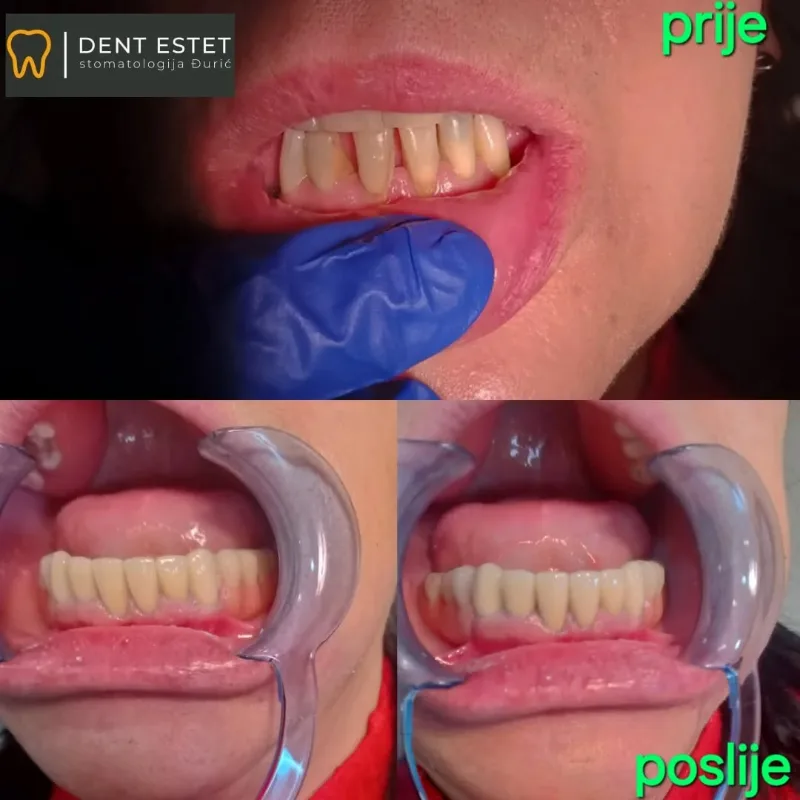 Prije i poslije: kombinovani rad u donjoj vilici